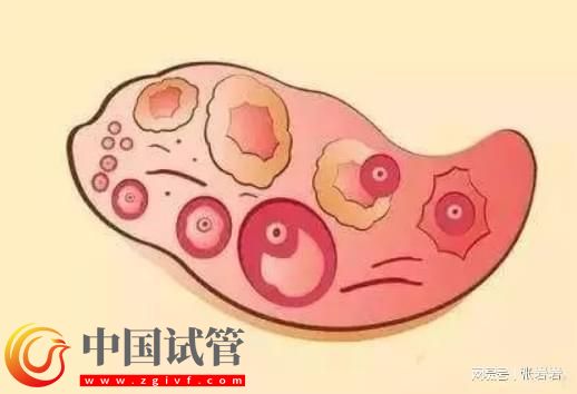 卵巢早衰卵泡不發(fā)育怎么辦？卵巢早衰可以借卵試管生孩子嗎？(圖7)