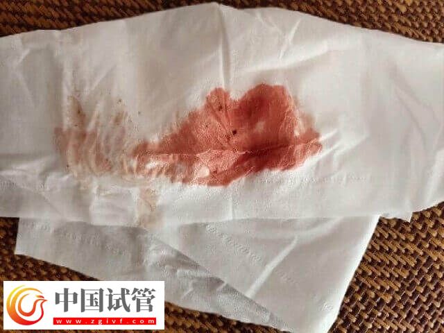 試管移植后不規則出血怎么辦(圖1)