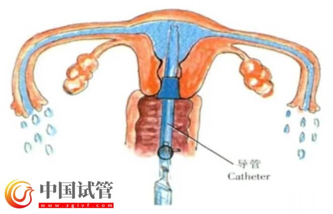 富血小板血漿PRP宮腔灌注后需注意3-7天內(nèi)禁止同房嗎？(圖1)