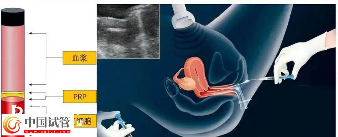 宮腔灌注具體的操作流程是怎么樣的？需要幾分鐘完成？(圖1)
