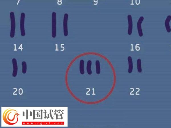 22號(hào)染色體異常還能不能要孩子(圖1)