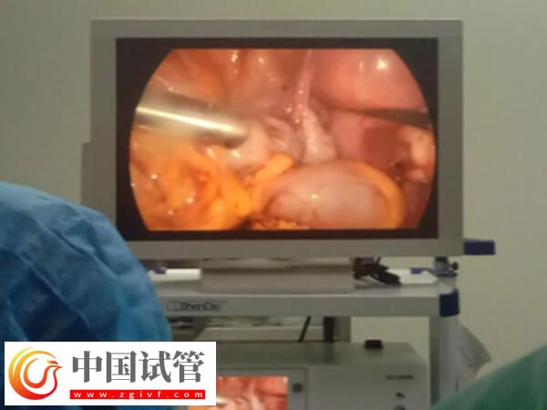 腹腔鏡子宮切除手術怎么做(圖5) 腹腔鏡子宮切除手術怎么做(圖5)