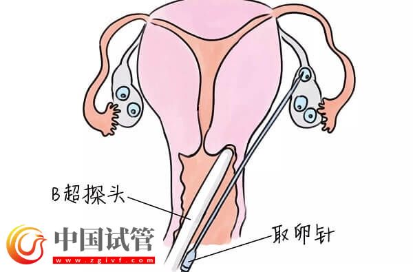 試管嬰兒中用果納芬好不好(圖3)