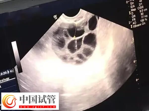 試管嬰兒助孕有幾個(gè)階段(圖2)