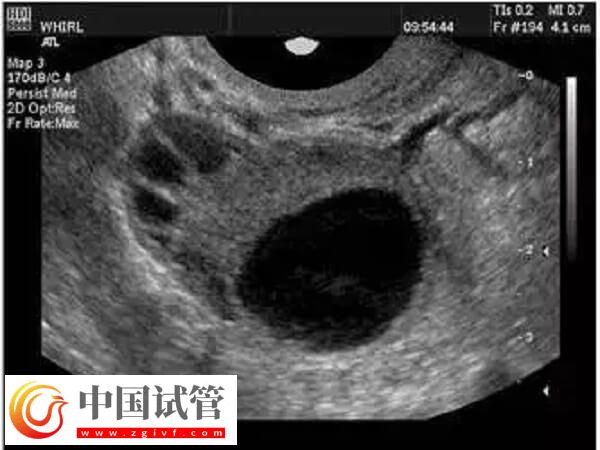 取卵為什么出現(xiàn)異形卵子(圖1)